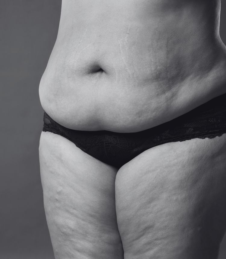 Image comparing mild and severe cellulite grades Lewes