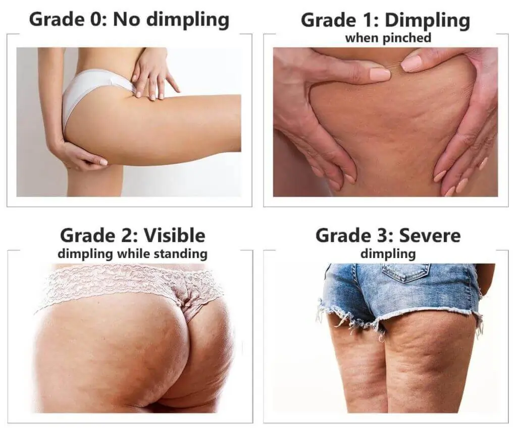 Representation of the stages of cellulite development Lewes